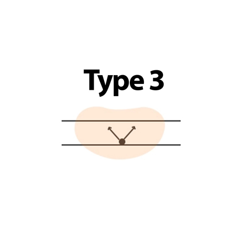 Type 3