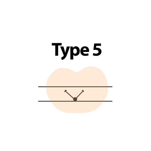 Type 5
